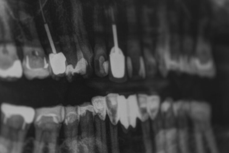 dental radiography - root canal treatment in geelong