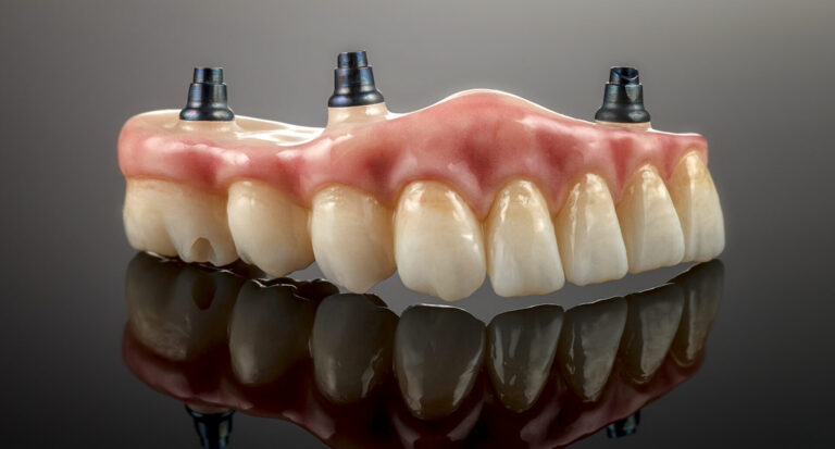 a model of all-on-4 dental implants in geelong