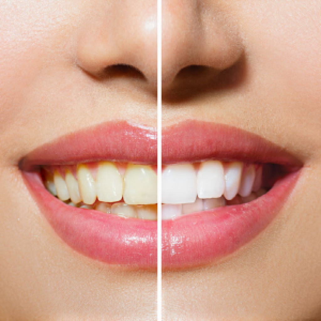 Teeth Whitening Geelong Dental Centre